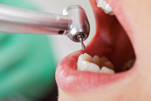 Best Emergency Root Canal Treatment in Reno, OH